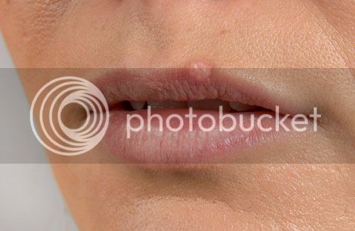 fever-blister-lips.jpg