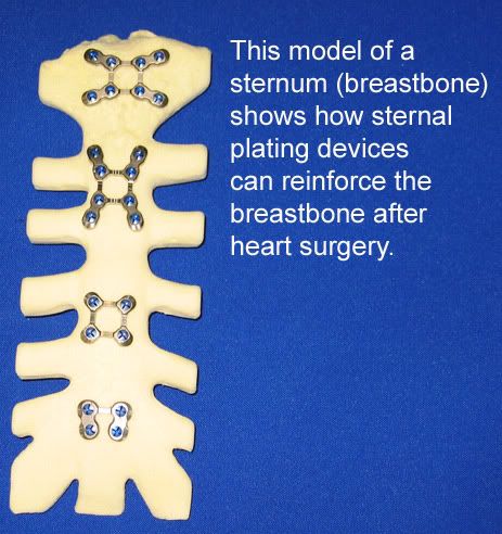 sternal-plating-heart-surgery.jpg