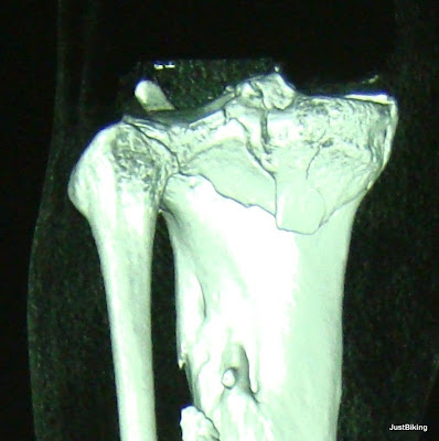 tibia-plato-1.jpg