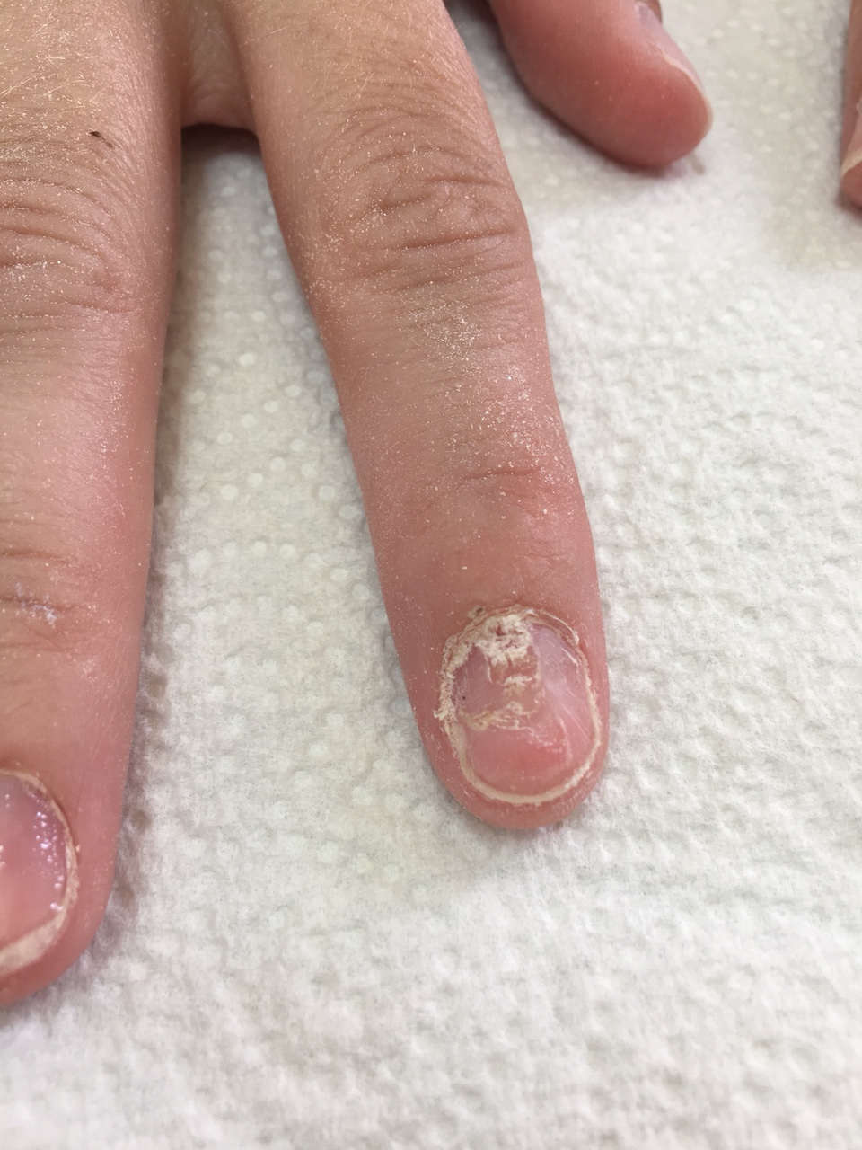 Clinico-etiological Study of Nail Disorders at a Tertiary Care Center in  Maharashtra, India | Journal of Skin and Stem Cell | Full Text