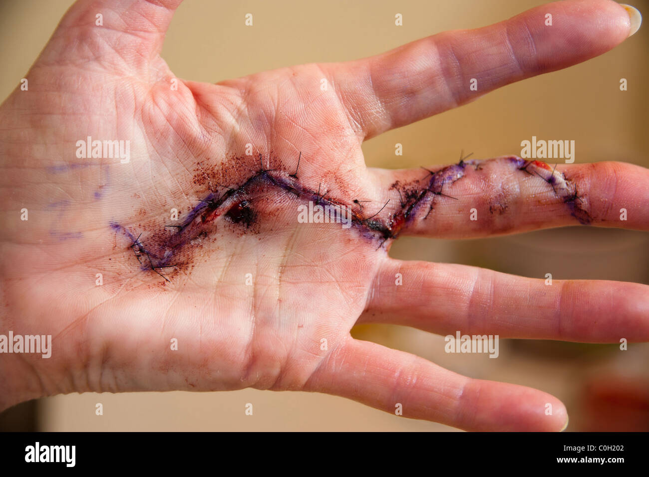 operation-scars-for-dupuytrens-contracture-C0H202.jpg