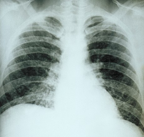 459px-Chest_X-ray_acute_pulmonary_histoplasmosis_PHIL_3954.jpg