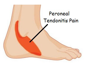 side-foot-pain-peroneal-tendonitis.jpg