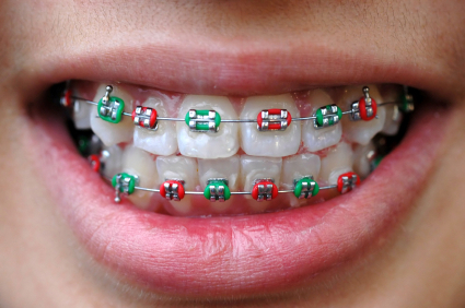 iStock_000002551343XSmall-colourful-braces-on-teeth.jpg