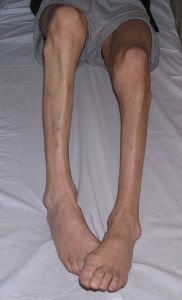 atrophy-leg-2.jpg