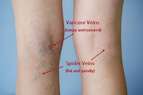 spider-vein-match.jpg