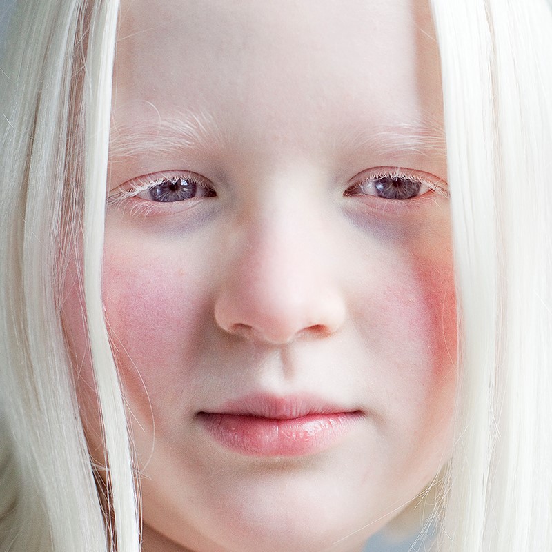 0235c-albinisme-anderskijken2.jpg