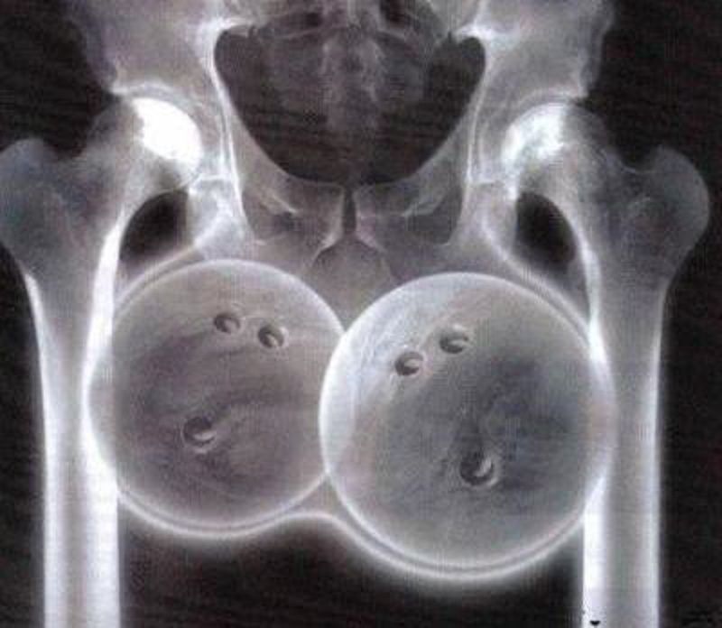 chuckyeagersx-ray.jpg