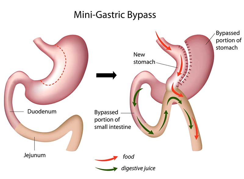 mini-gastric-bypass-header.jpg