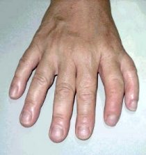 polydactyly.jpg