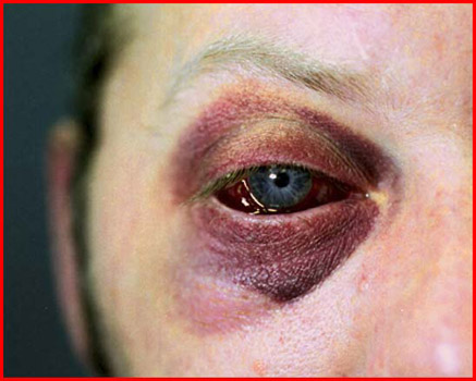 assault-black-eye.jpg