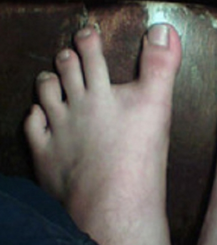 when-there-is-a-huge-gap-from-your-big-toe-to-the-second-toe_832539edd32dad0c6fbc2b1996ec3d59358a87f2.jpg