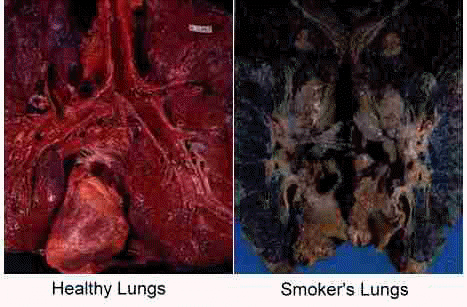 smokers+lungs.jpg