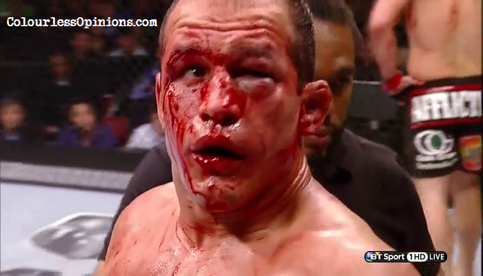 Junior+Dos+Santos+blood+covered+injured+face+in+UFC+166+versus+Velasquez.png