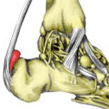 achilles-bursitis220.jpg