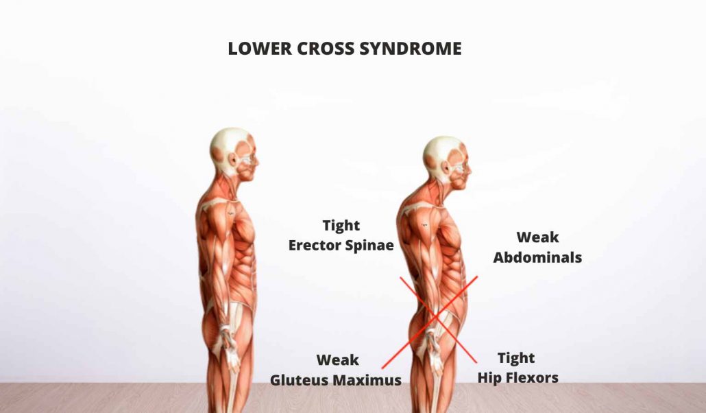 LCS-Lower-Cross-Syndrome-1030x602.jpg