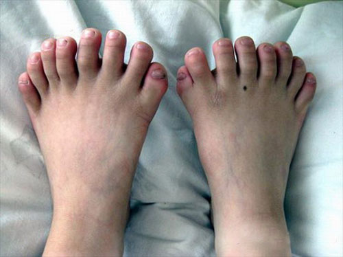 polydactyly.jpg