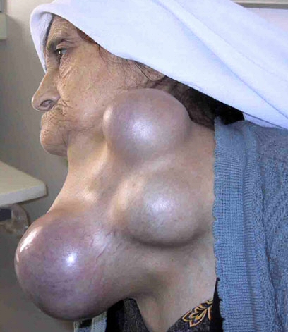 1goiter3.jpg