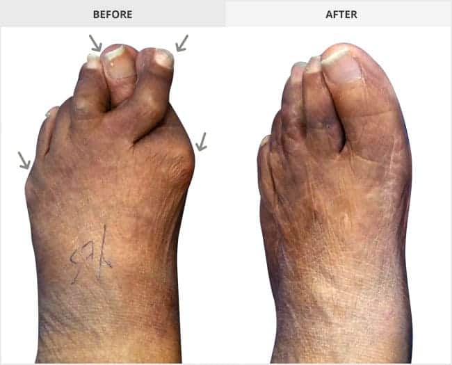 11-17-Bunion-correction-with-hammertoe-correction-2nd-and-3rd-toes-and-plantar-plate-repair-2nd.MAN_.jpg