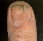 nail_pterygium.jpg