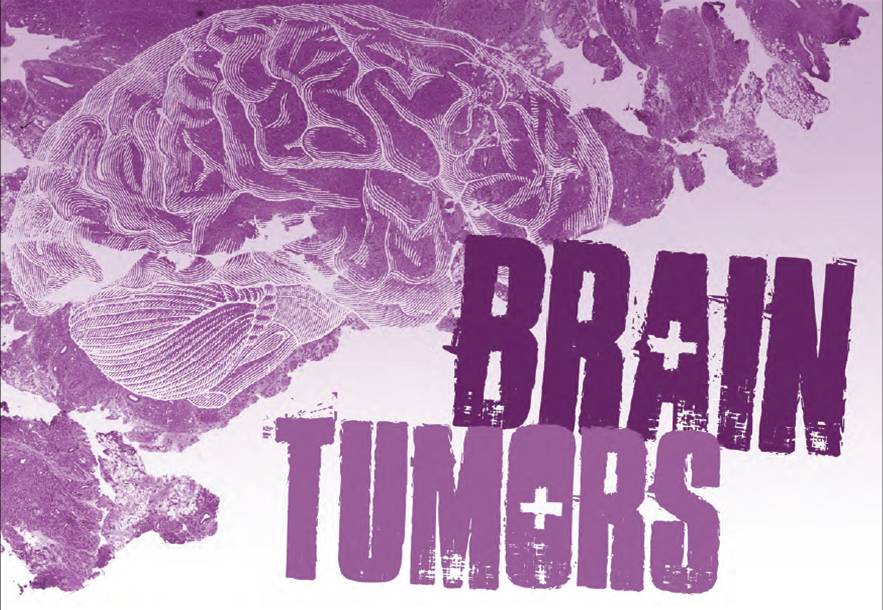 brain-tumors.jpg