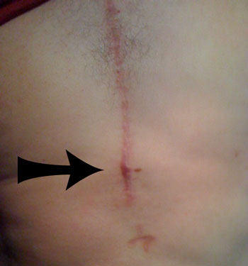 keloid-scar.jpg