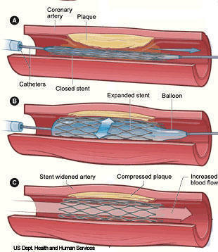 stent.jpg