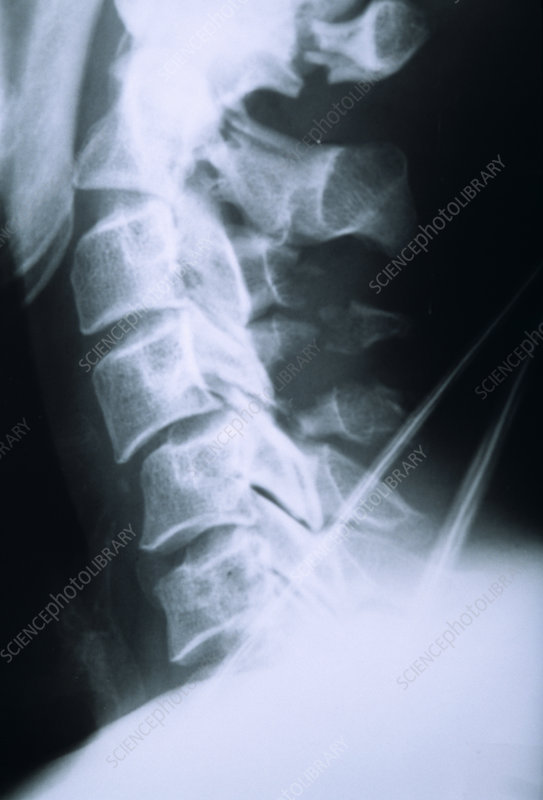 M3301077-Broken_neck,_X-ray-SPL.jpg