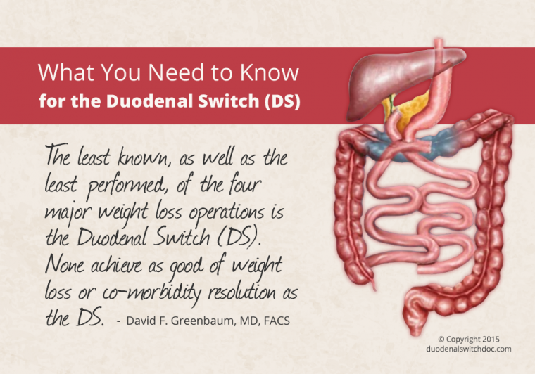 Duodenal-Switch-760x532.png