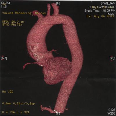 Pre-Surg_Aorta%20(Custom).JPG