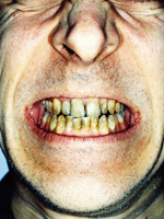 smokers-teeth-150.jpg